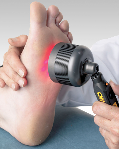 Laser Fungal Treatment