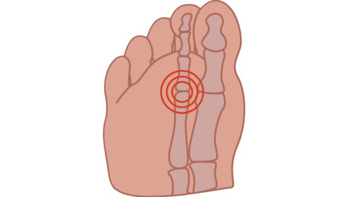 Capsulitis feet