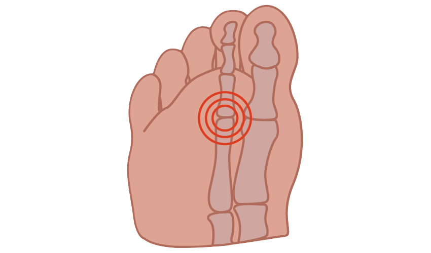 Capsulitis feet