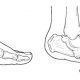 Charcot Foot Example