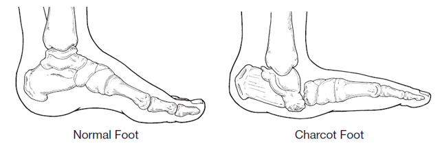 Charcot Foot Example